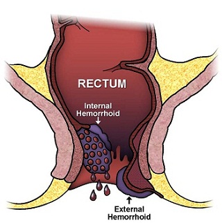 piles surgeon in Pune